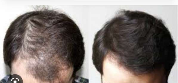Мезотерапия волос от выпадения в Москве фото 3