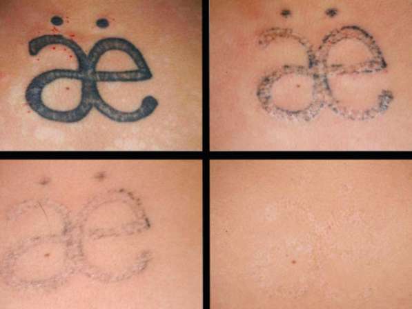 Удаление татуировок лазером без шрамов. карбоновый пилинг в Одинцово фото 4
