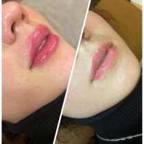 Увеличение губ, в Москве