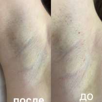 Шугаринг, в Ростове-на-Дону